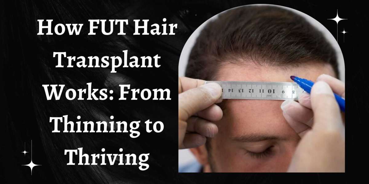 How FUT Hair Transplant Works: From Thinning to Thriving